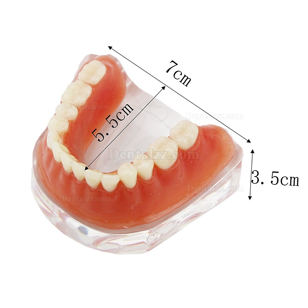 歯科下顎インプラント義歯模型モデル バーアタッチメント治療説明歯列模型 クリアベース 4本インプラント