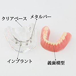 歯科下顎インプラント義歯模型モデル バーアタッチメント治療説明歯列模型 クリアベース 4本インプラント